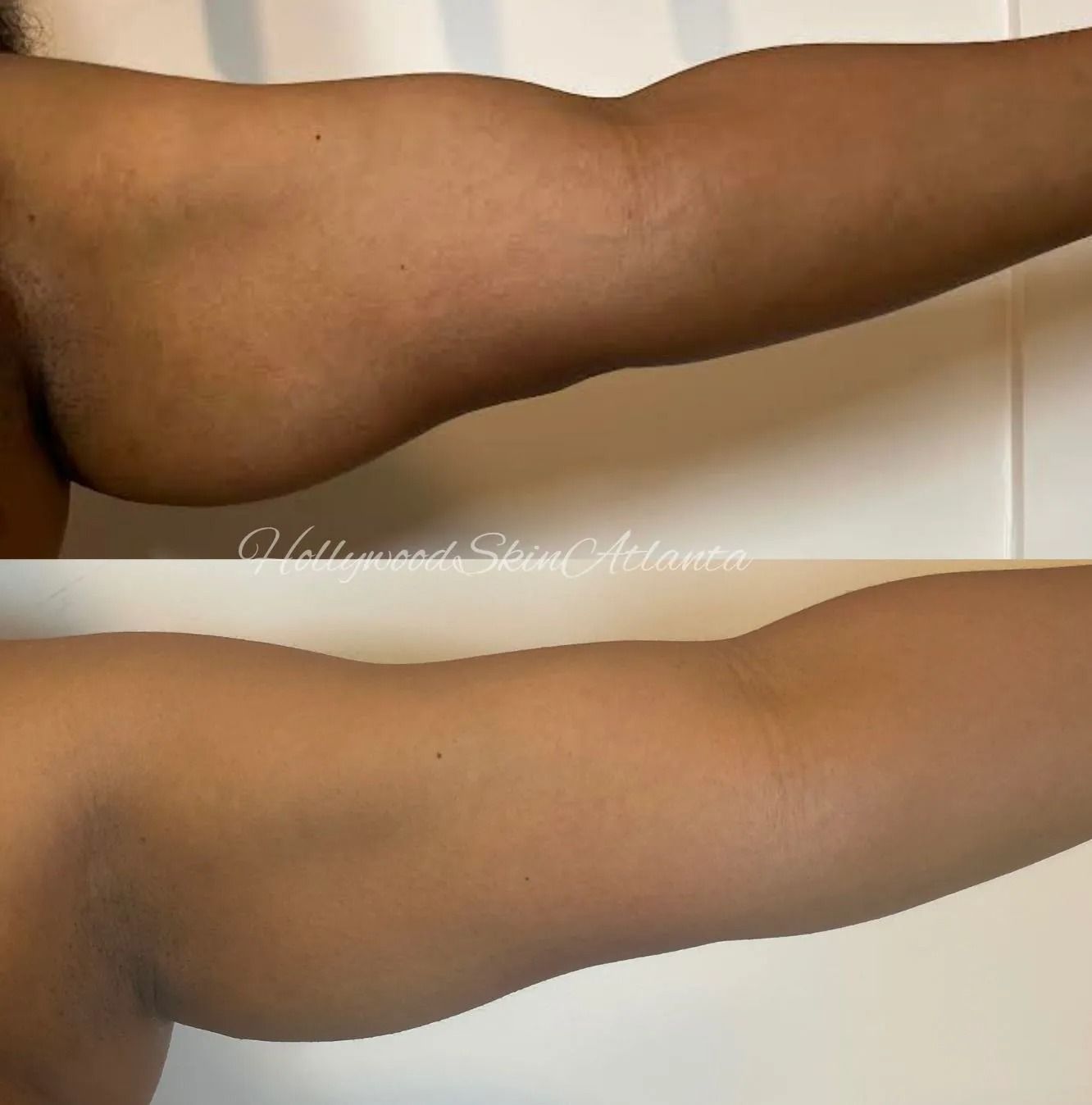 Body Slimming Treatments