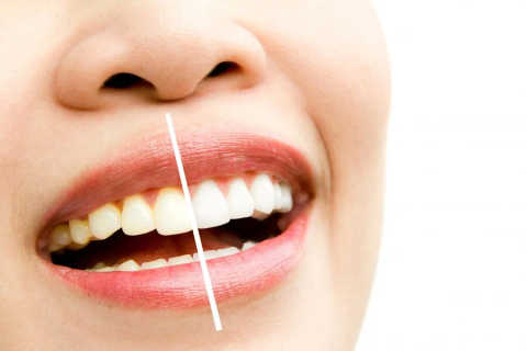 Teeth Whitening service