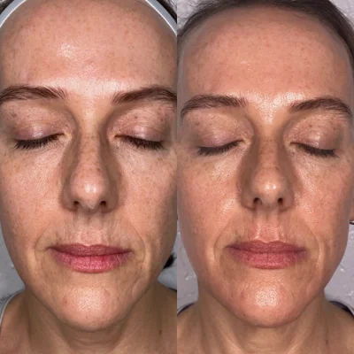  skin-care,beauty-treatment,facial-improvement,before-and-after 