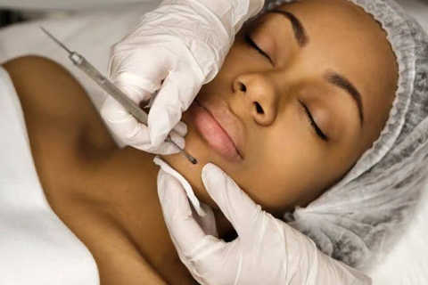 Electrolysis Hair Removal, 60 Min