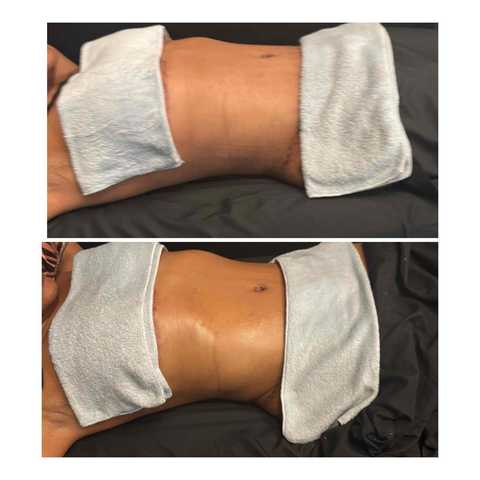 Post-Op Brazilian Lymphatic Drainage