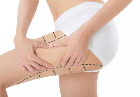 Bliss Fat Reduction Outer Thigh