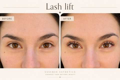 Microneedling