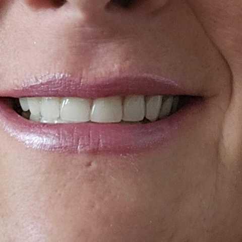 Lip Flip