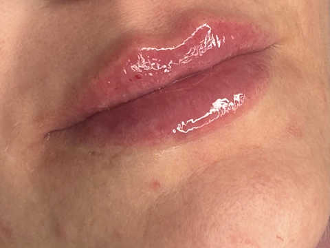 Dermal Filler (Lip Enhancement) | New Patient
