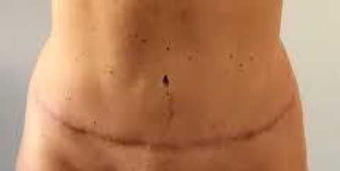 Scars and Birthmarks Cover up’s