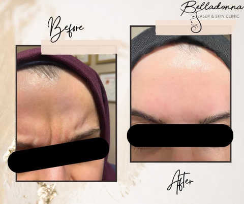 Wrinkles treatments non invasive