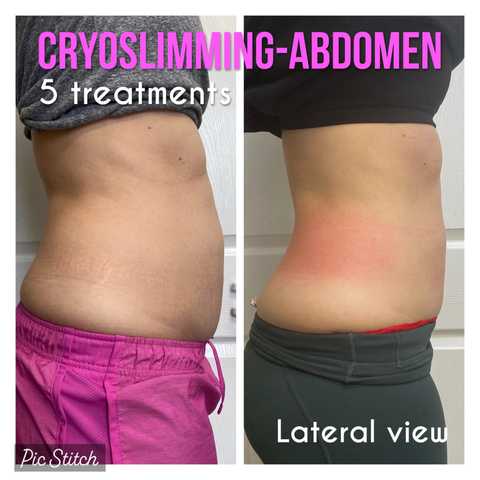 Cryo Slimming