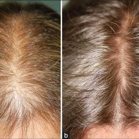 Hair Fall Treatments