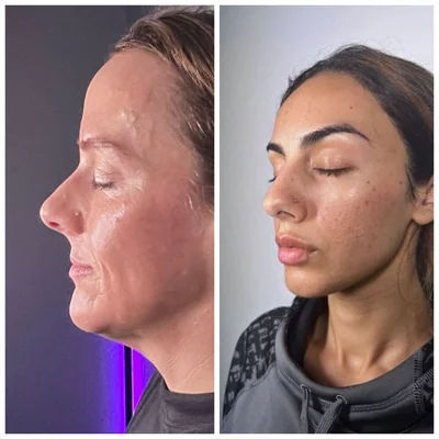  facial-treatment,before-after,skincare,cosmetic-procedure 
