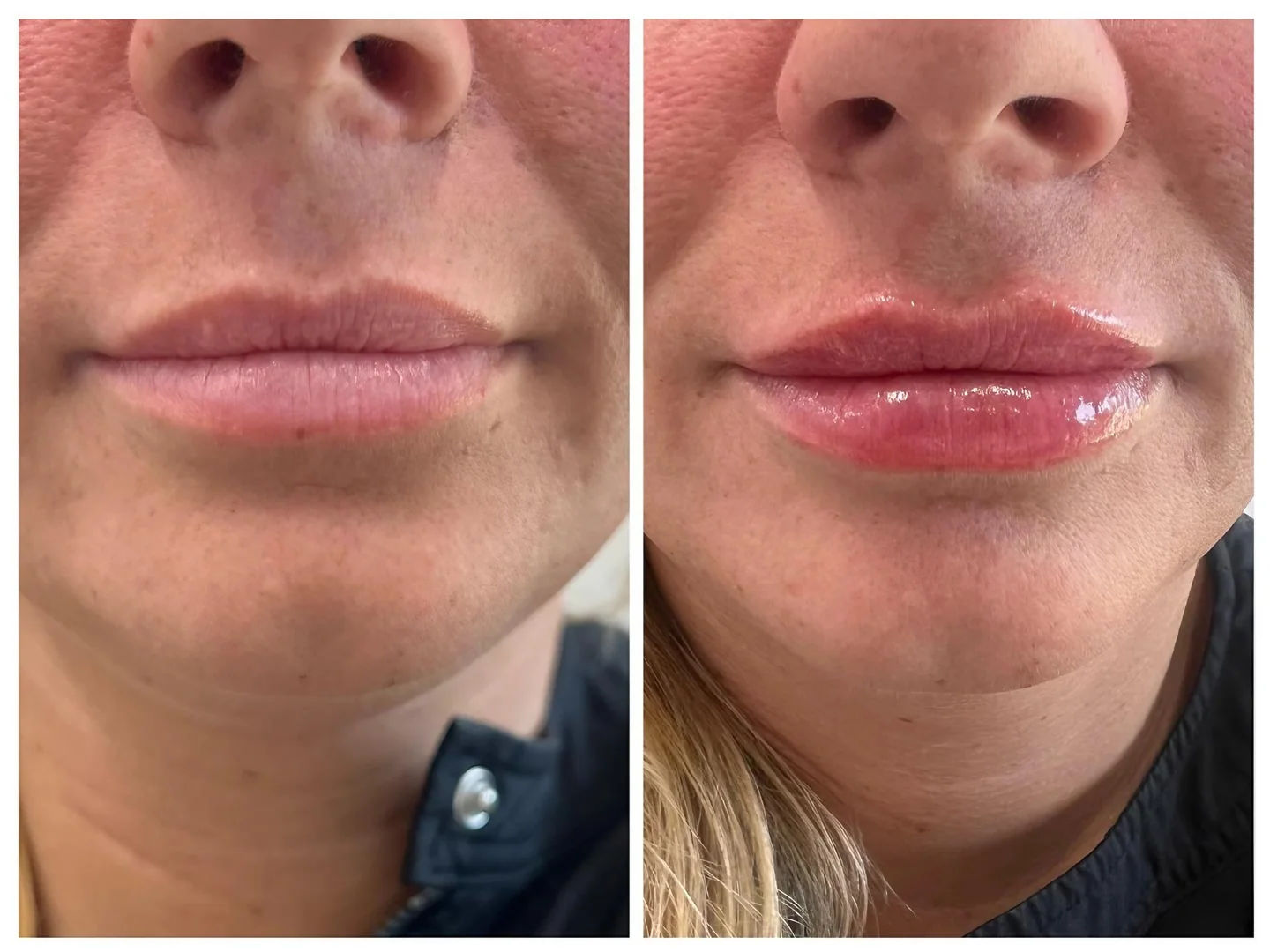  before and after,lips,cosmetic treatment,beauty  