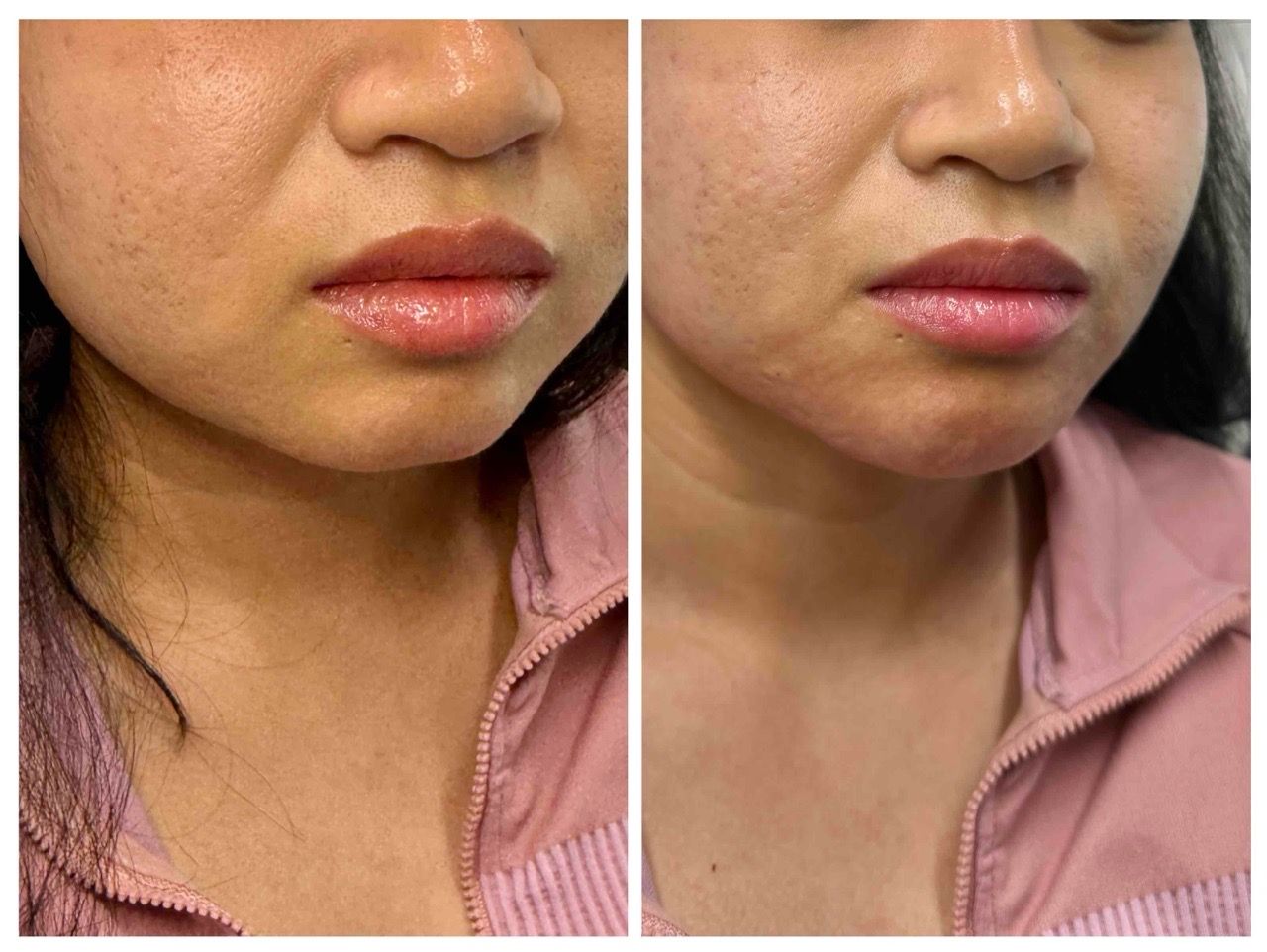  before and after,skincare,transformation,facial 