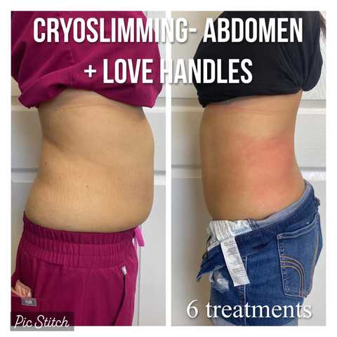 Cryo Slimming