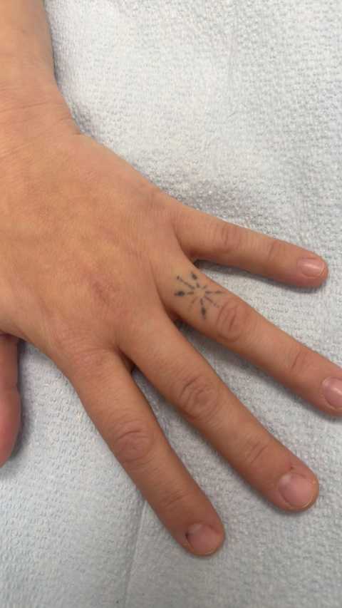 Tattoo Laser Fading & Removal