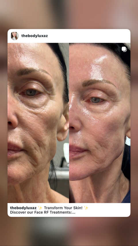 Skin Tigthening / Rejuvenation service