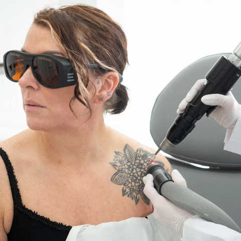 Tattoo Laser Fading & Removal