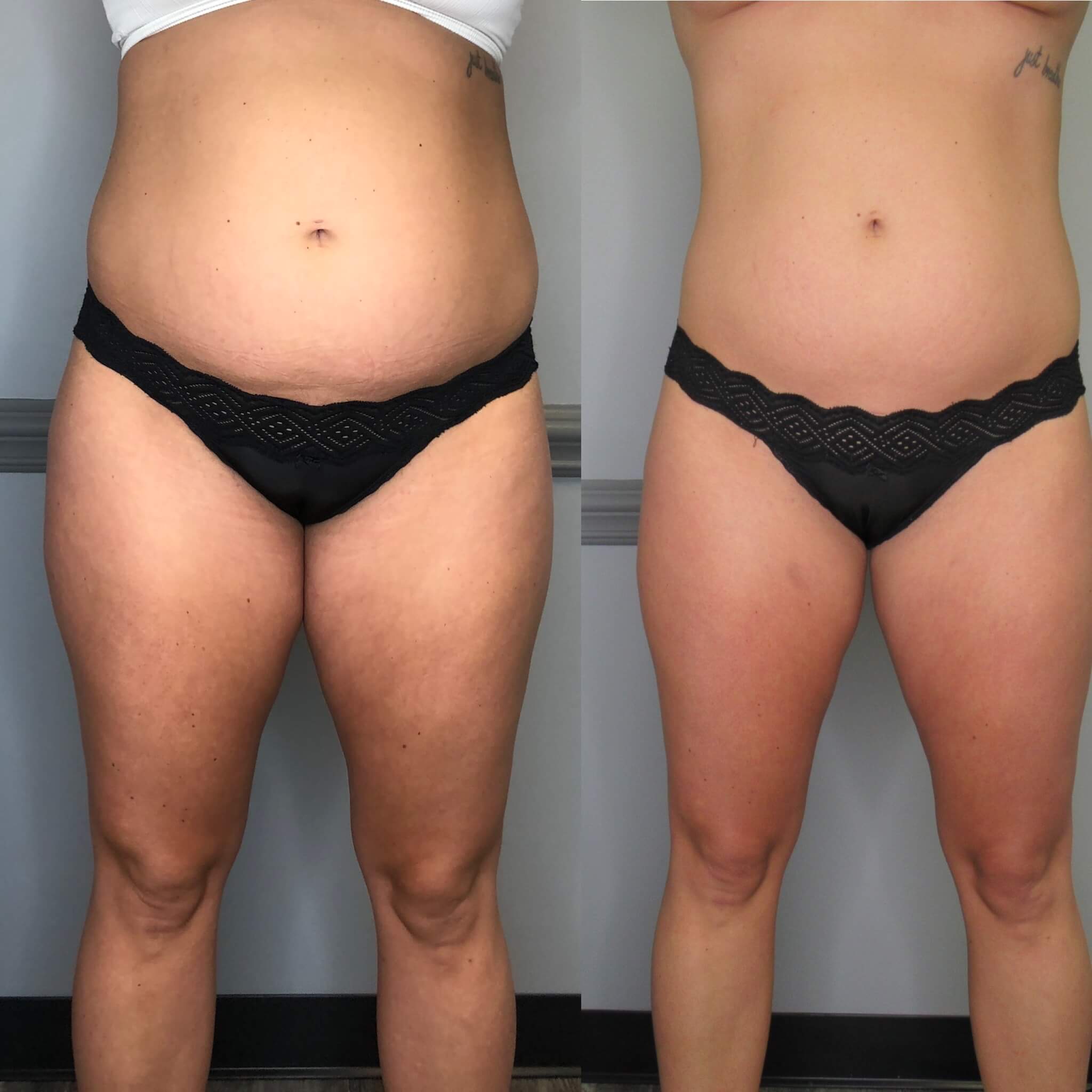  before-after,body-contouring,service-result,medspa  