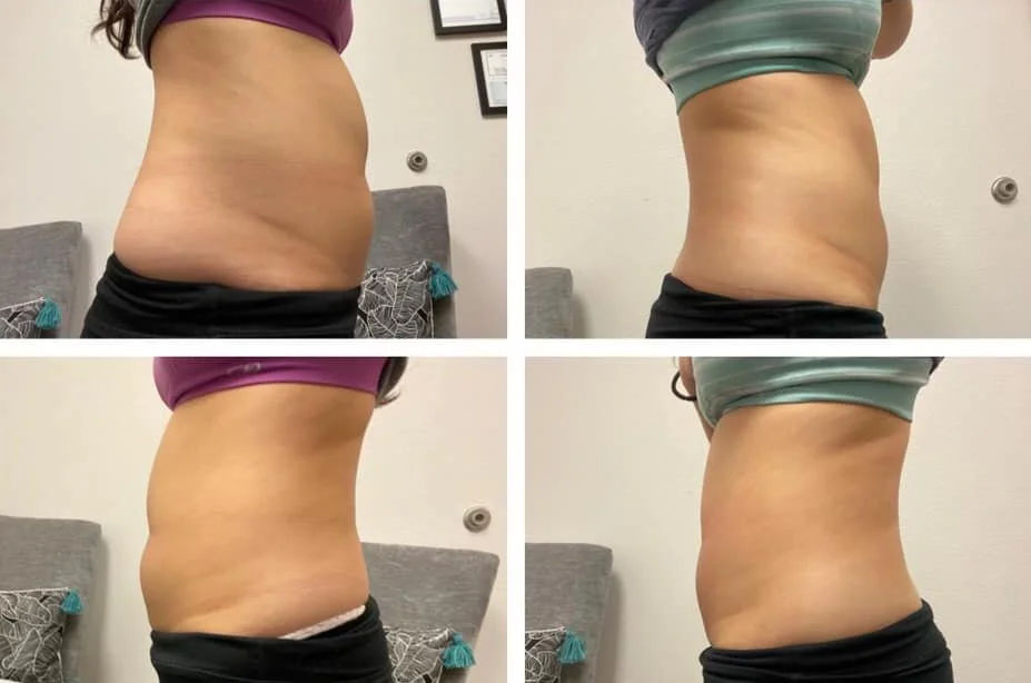  before-and-after,transformation,body-contouring  