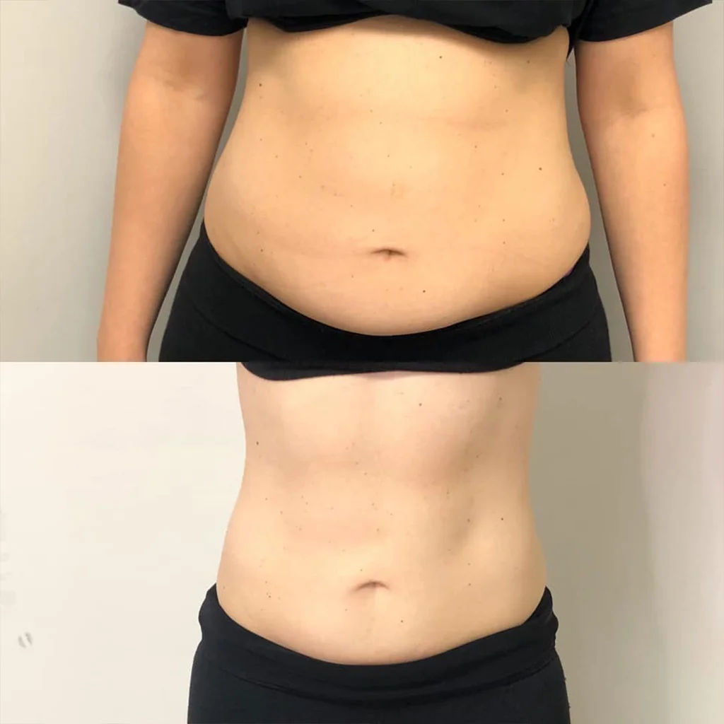  before-and-after,body-treatment,skin-care  