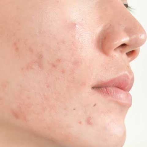 Detoxifying Facial Acne Grades I & II