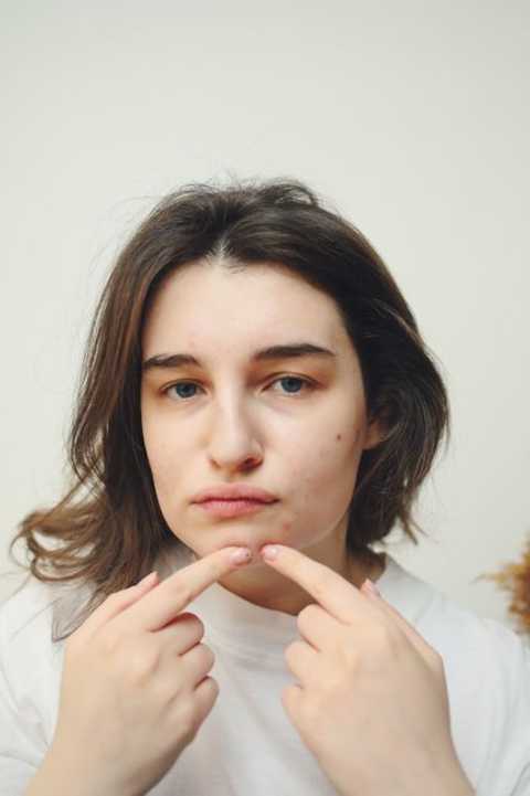 Detoxifying Facial Acne Grades I & II