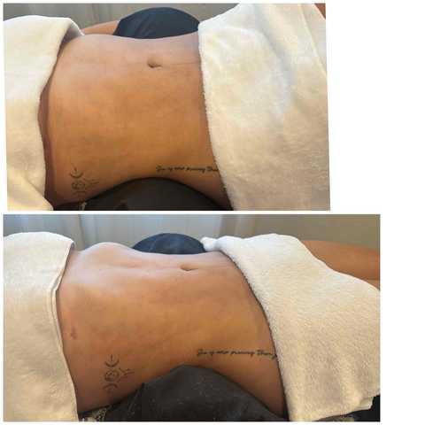 Post-Op Brazilian Lymphatic Drainage