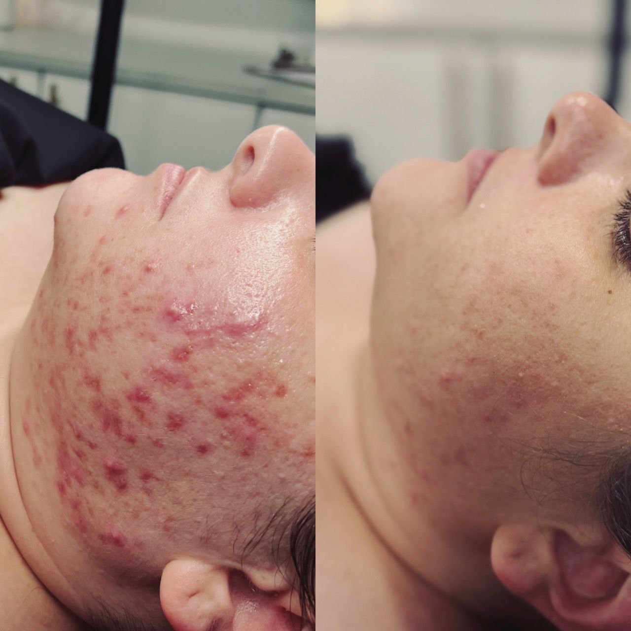  skincare,before and after,acne treatment,facial results 