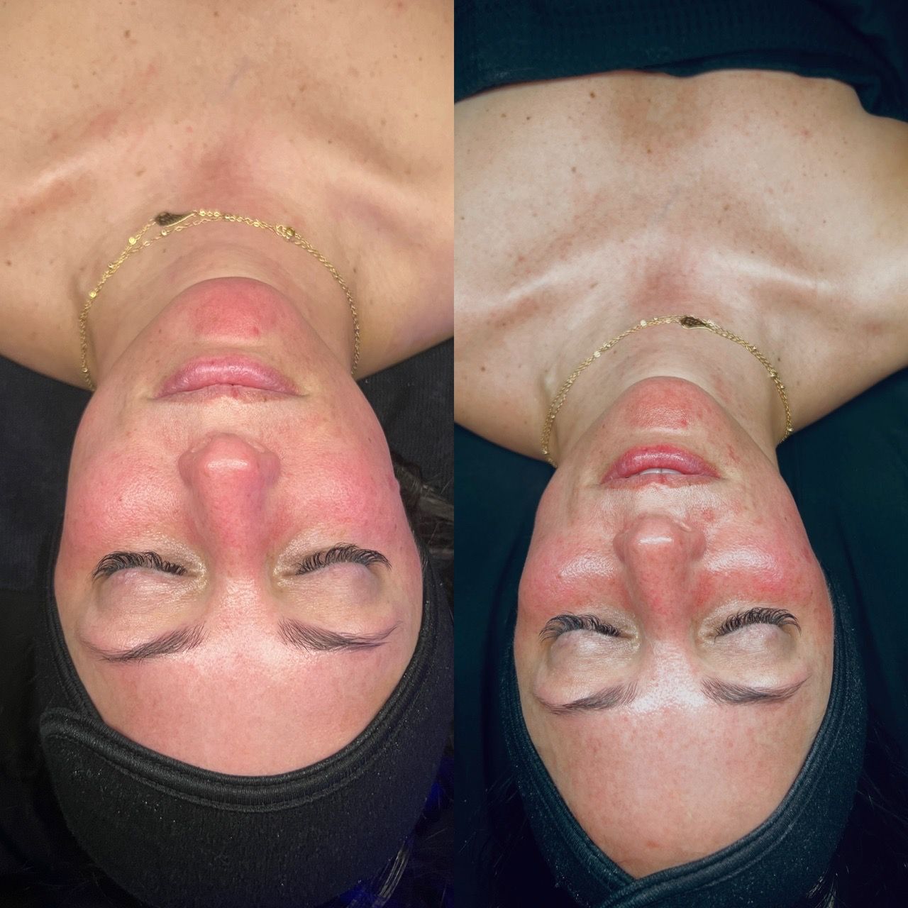  before-and-after,facial-treatment,skincare,beauty 