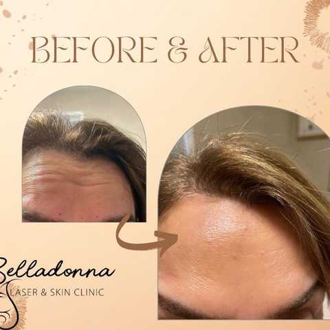 Botox