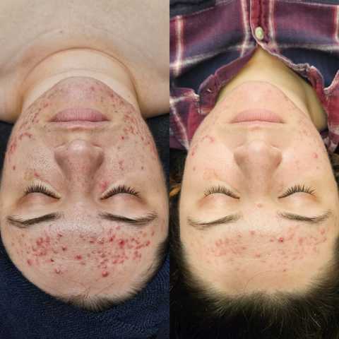 Vi Peel - Face