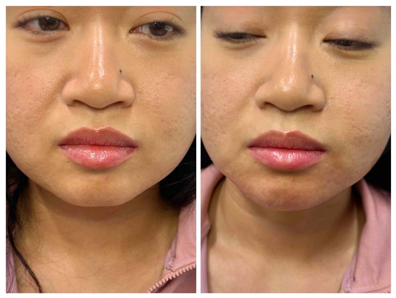 before-after,facial treatment,skin care,transformation