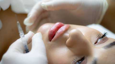 Filler - Restylane service