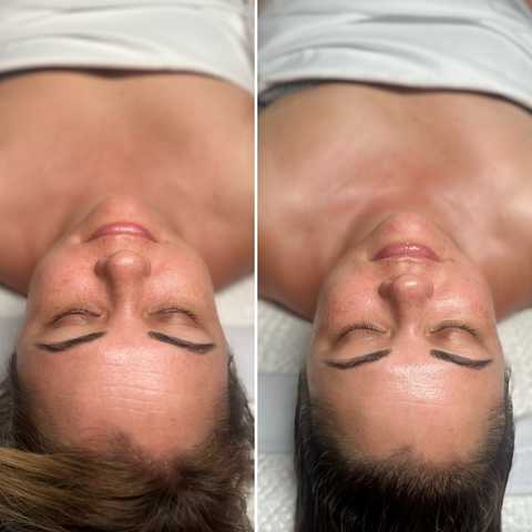 Acne Treatment Facial