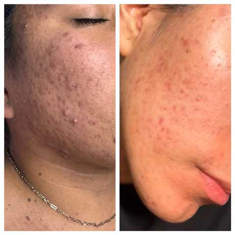 Peeling System Acne Pigment for Post-Acne Dark Spots & Texture blog