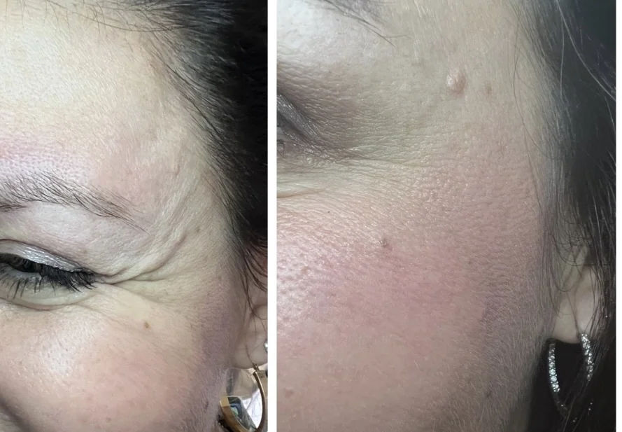  before and after,skin treatment,facial comparison,wrinkle reduction  