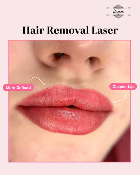 Laser hair removal