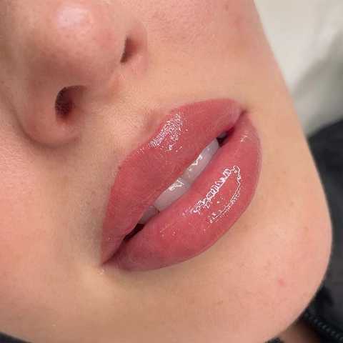 Lip Fillers service