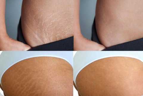 Scar and stretch mark camouflage service