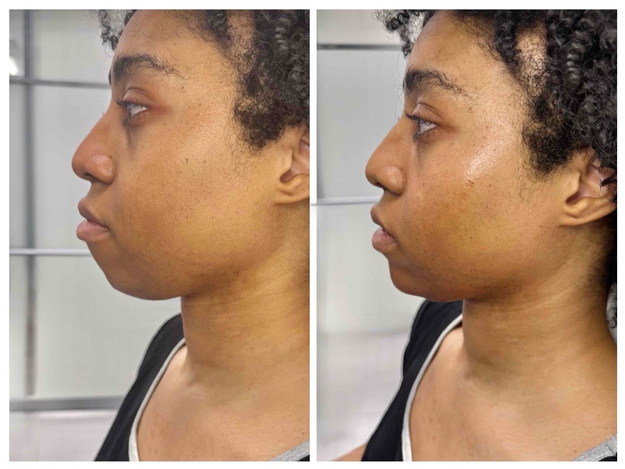 before and after,skin care,transformation,facial profile,comparison