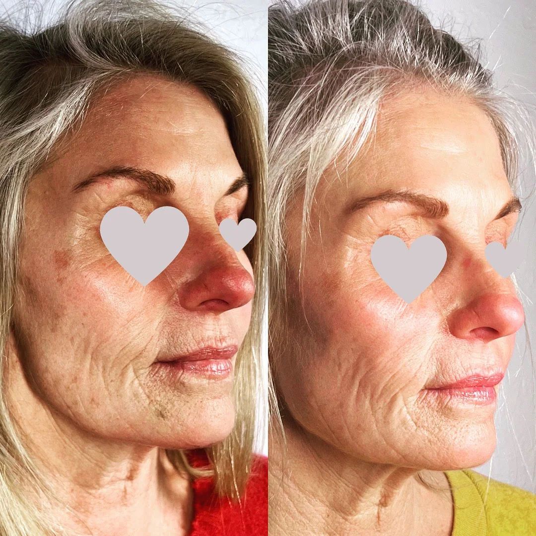  before-after,skin-treatment,facial,beauty  