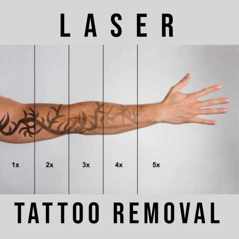 Laser Tattoo Removal 6X6