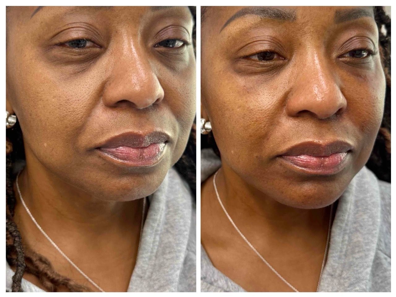 before after,transformation,treatment,facial