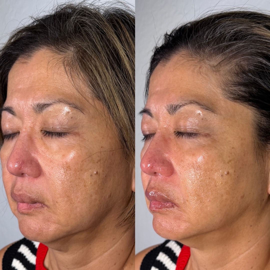  before-and-after,facial-treatment,skin-rejuvenation,complexion,hyperpigmentation,skin-texture,client-result,close-up,skincare 