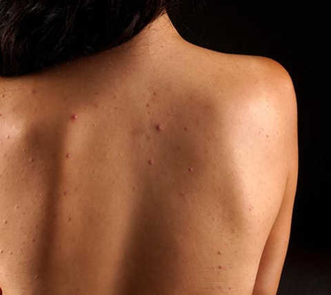 Acne Treatments service