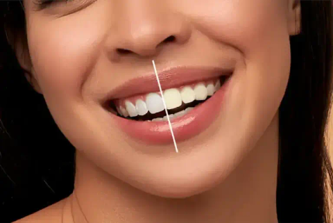 Teeth Whitening service