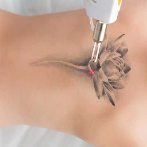 Tattoo Removal service