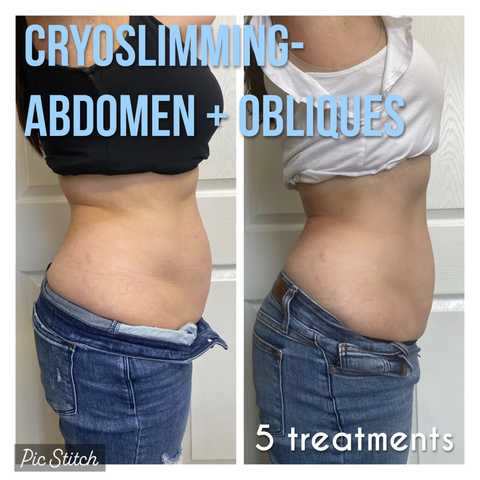 Cryo Slimming