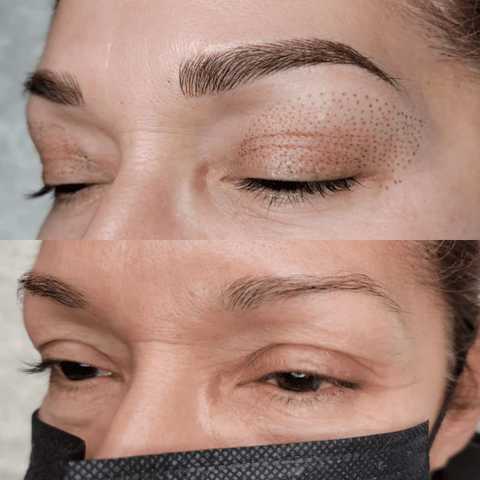 FibroBlast service