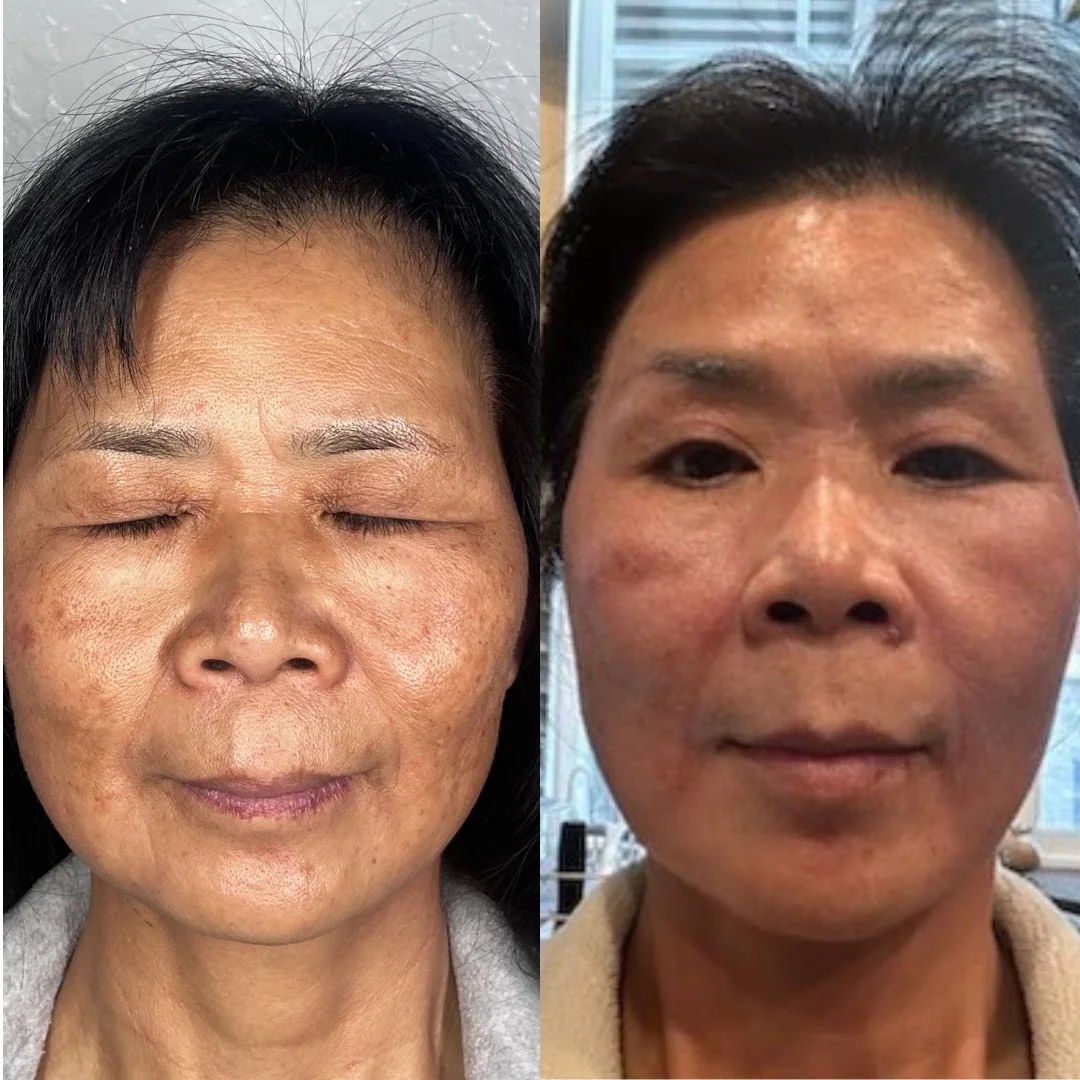  before-and-after,skincare,treatment,result,facial  