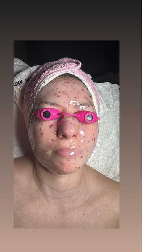 Peeling System Acne Pigment